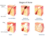 Stages of Pimples